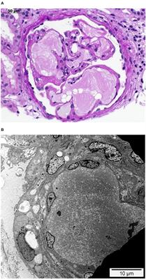 Case Report: Lipoprotein Glomerulopathy Complicated by Atypical Hemolytic Uremic Syndrome